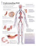 Understanding PAD Laminated Poster