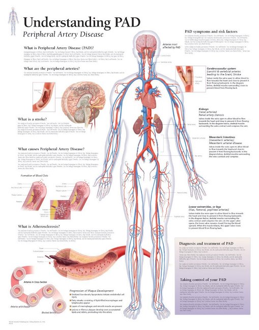 Understanding PAD Laminated Poster